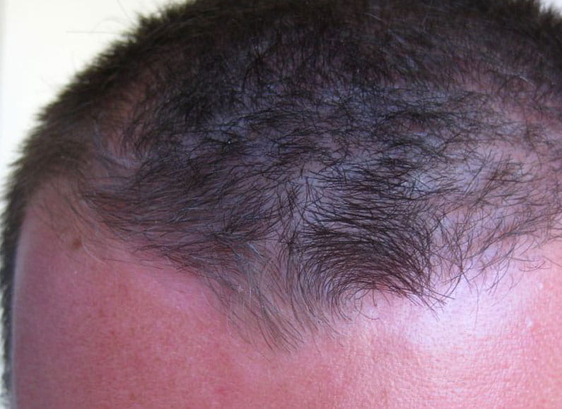Псориаз волосистой части головы после применения крема Лостерин