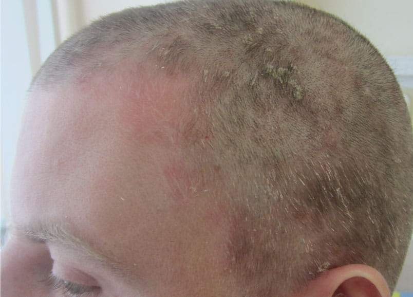 Фото 1. Псориаз волосистой части головы до применения шампуня Лостерин