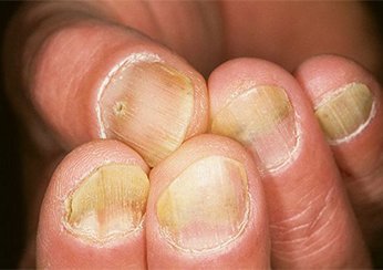 Отличия псориаза и грибка ногтей