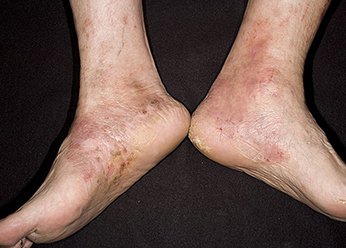 Роговая, тилотическая экзема на ногах