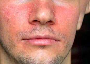 Симптомы себорейного дерматита: покраснение и шелушение