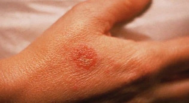 Монетовидная экзема: причины, лечение, симптомы, эффективные методики ...