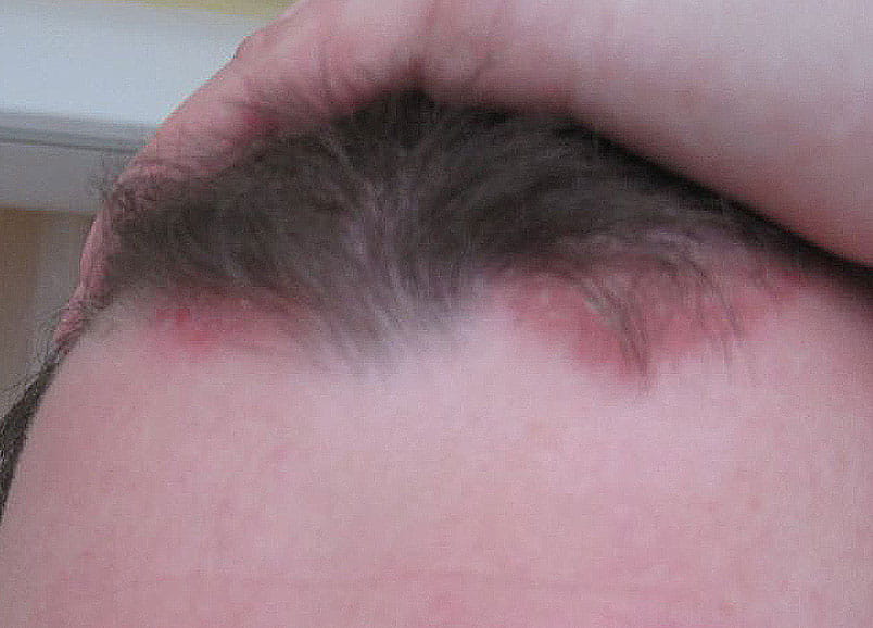 Псориаз волосистой части головы до применения крема Лостерин