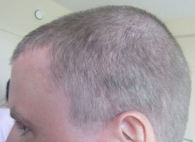 Фото 2. Псориаз волосистой части головы после применения шампуня Лостерин