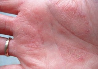 Лечение контактного дерматита на руках