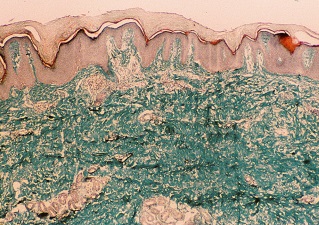 Экзема, клетки кожи под микроскопом