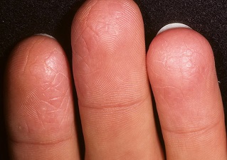 Хроническая экзема пальцев