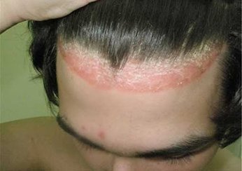 Лечение псориаза кожи головы