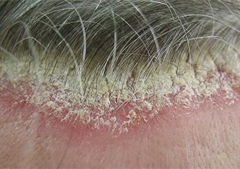 Псориаз волосистой части головы