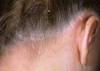 Псориаза волосистой части головы