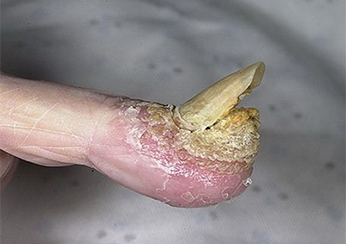 Симптомы ладонного псориаза: отслаивание ногтевых пластинок