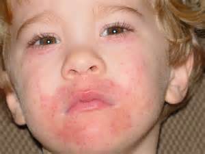 Атопический дерматит у ребенка 3-5 лет