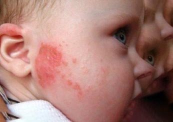 Причины возникновения на лице у ребенка дерматита