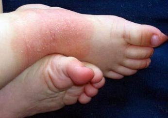 Лечение дерматита на ногах у ребенка