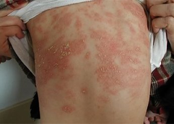 Аллергический дерматит на спине