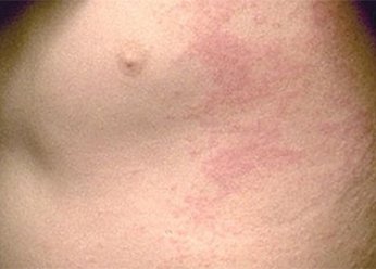 Аллергический дерматит на груди