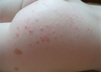 Атопический дерматит на попе у ребенка