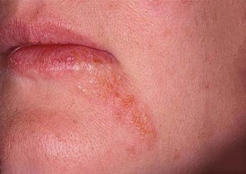 Особенности проявления и лечения периорального дерматита на лице
