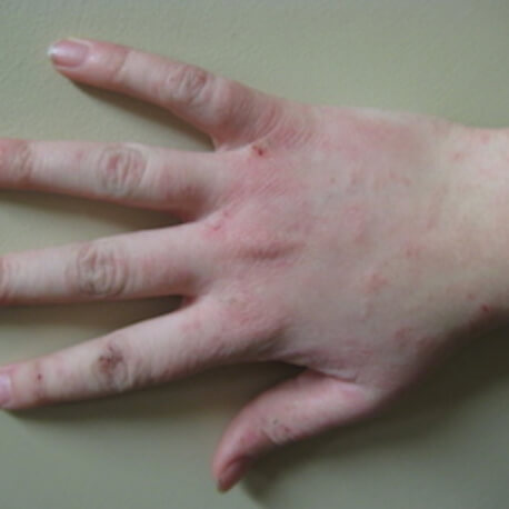 Холодовой дерматит на руках