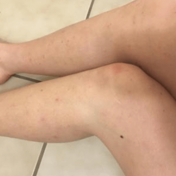 Холодовой дерматит на ногах