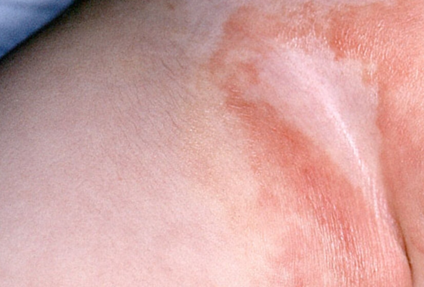 Кандидозный дерматит у лежачих больных thumbnail