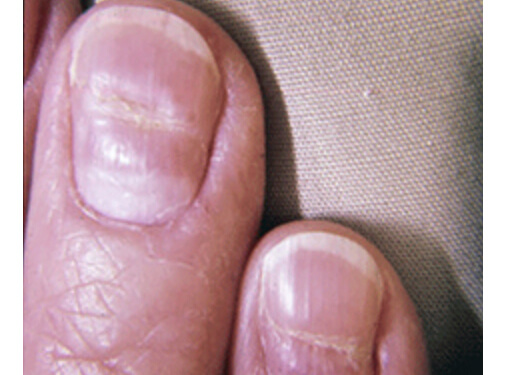 Экзема ногтей на ногах лечение